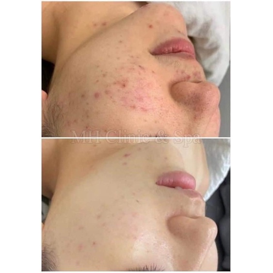 Kem dưỡng GIGI Bioplasma Azelaic Cream 15% 10ml