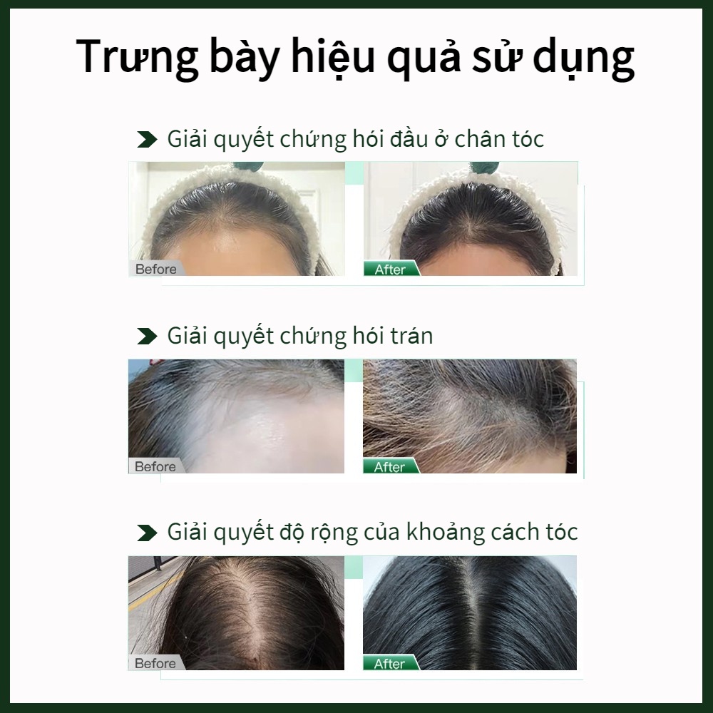 Tinh Chất Kích Thích Mọc Tóc Cải Thiện Tình Trạng Rụng Tóc 30ml