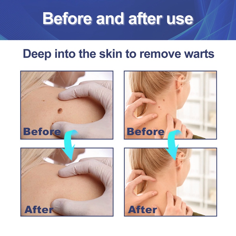 Bộ 144 Miếng Dán Hỗ Trợ Giảm Mụn Chiết Xuất Thảo Dược