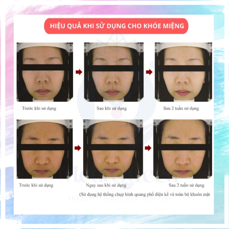 Gel Nâng Cơ Xóa Nhăn CareCella Facial line up lifting gel 16 gói x 9ml