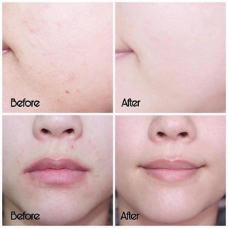 [Hàng chính hãng] Serum SVR Sebiaclear giảm mụn mờ thâm