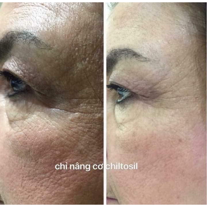 Serum Tế Bào Gốc Chỉ Tơ Tằm Kéo Sợi Chitossil Thread Lift Ampoule 521 - Tách Lẻ