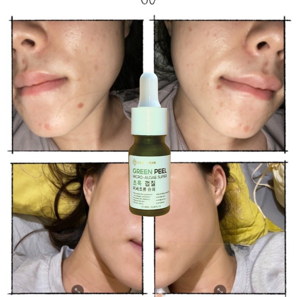 Peel Da Vi Tảo Tái Tạo Da Làm Mờ Vết Thâm Nếp Nhăn, Sẹo Lột Da Để TẩyTế Bào Chết. Thích Hợp Cho Mặt, Nách, Mông Và Lưng
