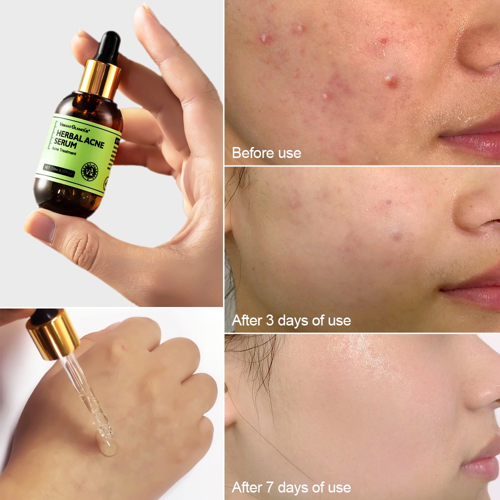 Bộ 2 sản phẩm chăm sóc da mặt VIBRANT GLAMOUR hỗ trợ làm giảm mụn chăm sóc da chuyên dụng