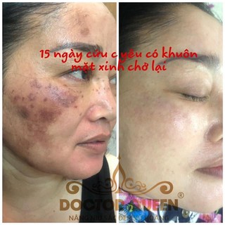 combo nám Doctorqueen ( gồm kem nám,kem trống nắng,serum vàng )