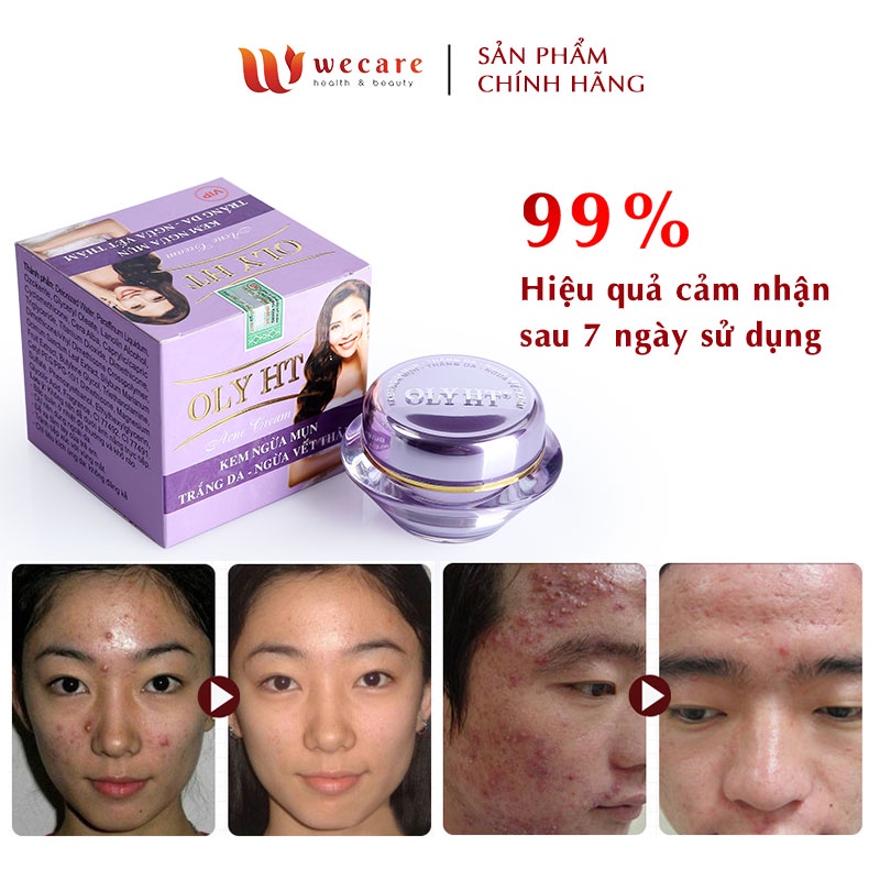 Kem Ngừa Mụn - Trắng Da - Ngừa Vết Thâm OLY HT 25g - OLY-010