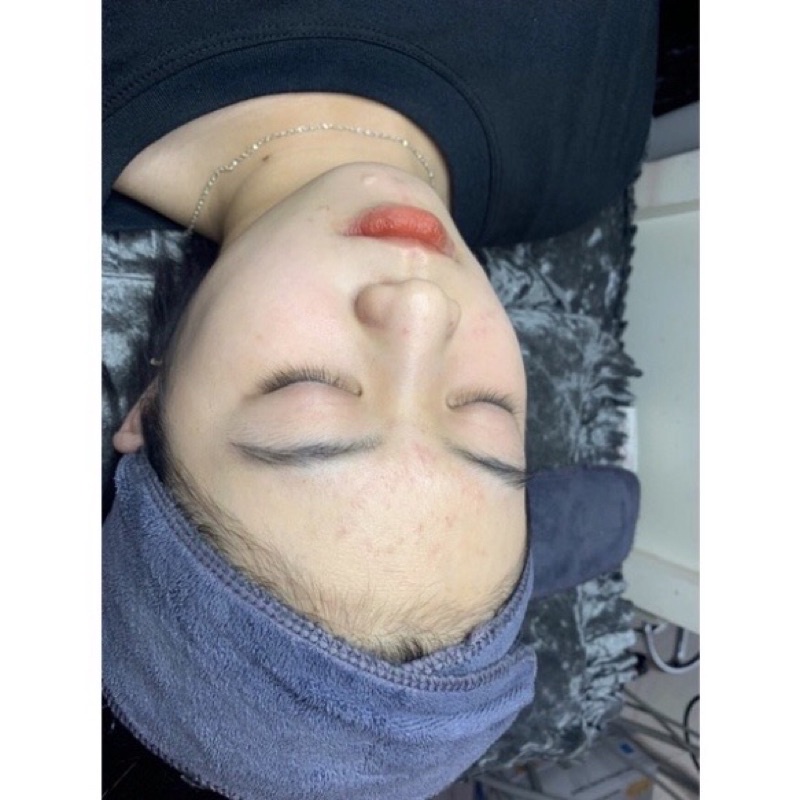 Serum moc tuyet giam mun giam tham