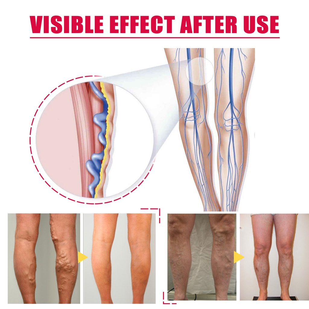 Kem chăm sóc tĩnh mạch Rose Vein Vein Cải thiện tuần hoàn máu Chăm sóc Massage chân bạch huyết