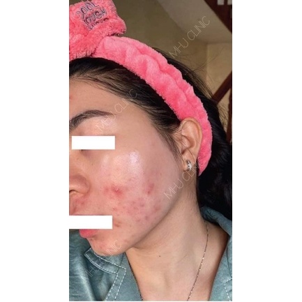 Kem dưỡng GIGI Bioplasma Azelaic Cream 15% 10ml