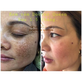 combo nám Doctorqueen ( gồm kem nám,kem trống nắng,serum vàng )