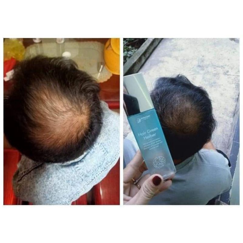 XỊT DƯỠNG NGĂN RỤNG VÀ KÍCH THÍCH MỌC TÓC HAIR GREEN HERBER QUYÊNLARA