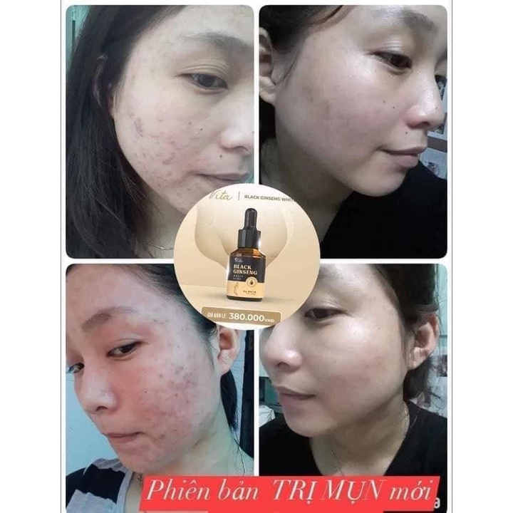 Tinh chất mụn VITA Black Ginseng Dr.Lacir