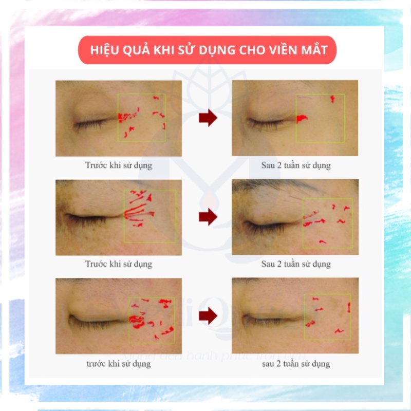 Gel Nâng Cơ Xóa Nhăn CareCella Facial line up lifting gel 16 gói x 9ml