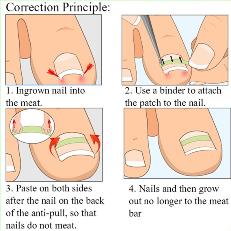 Set 10 Dụng Cụ Chỉnh Sửa Móng Chân Mọc Ngược Tiện Lợi