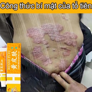 Kem vẩy nến Eczema Antipruritic tác dụng nhanh 15g Chống ngứa viêm da, hắc lào, bạch sản, nấm da chân, mề đay, viêm da