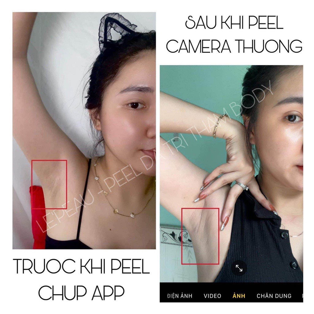 Peel nách retinol, peel chân, khử thâm và làm trắng da Lepeau chính hãng