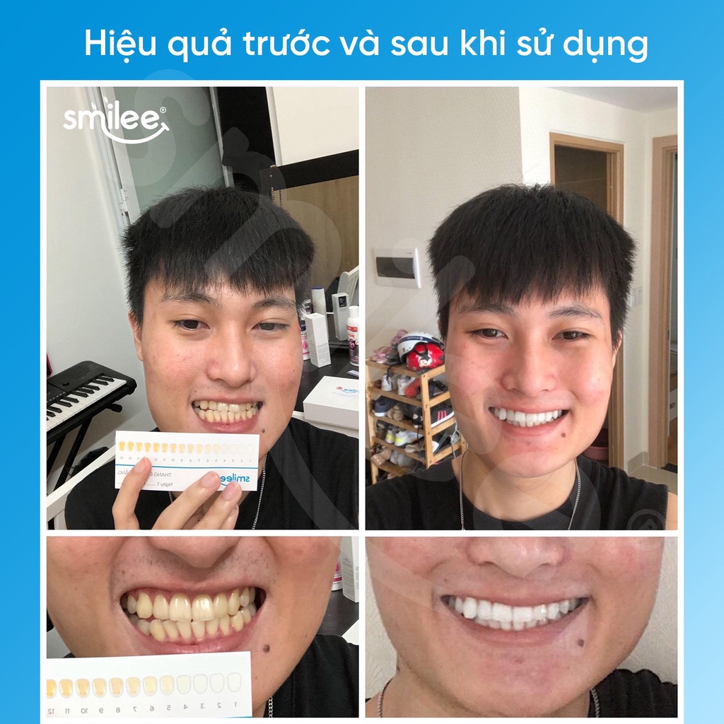 Bộ Kit tẩy trắng răng Smilee Max sử dụng tại nhà - Hàng chính hãng