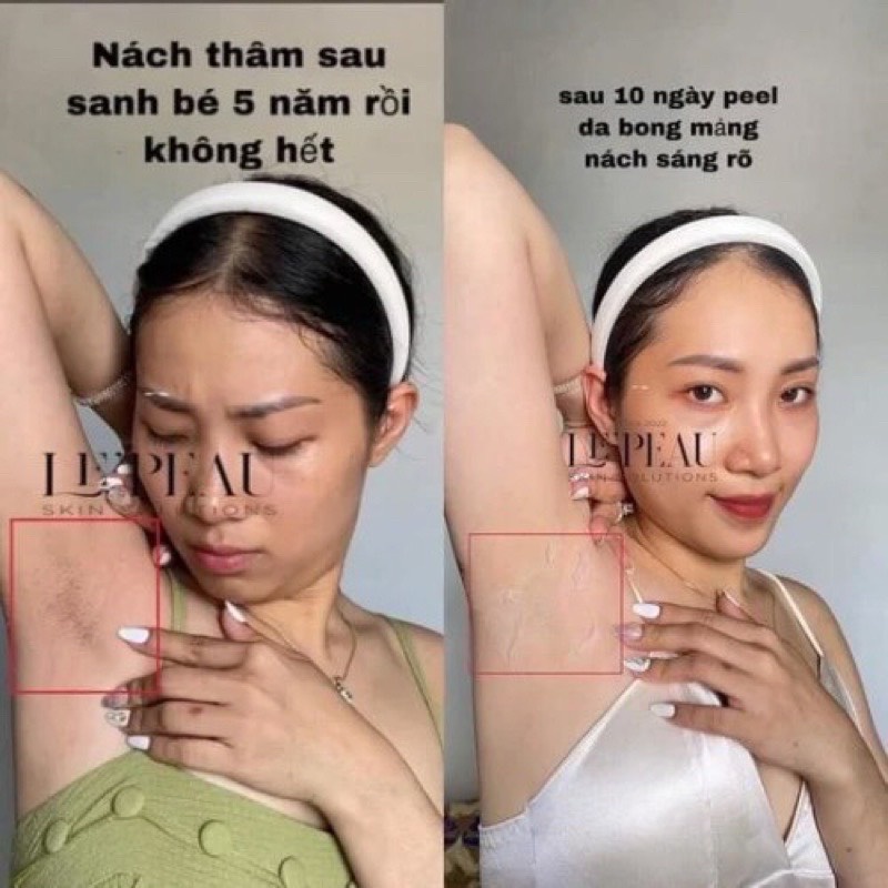 - Kem bong da, Peel nách Retinol, peel chân, peel body, khử thâm làm trắng da toàn thân Lepeau - chính hãng