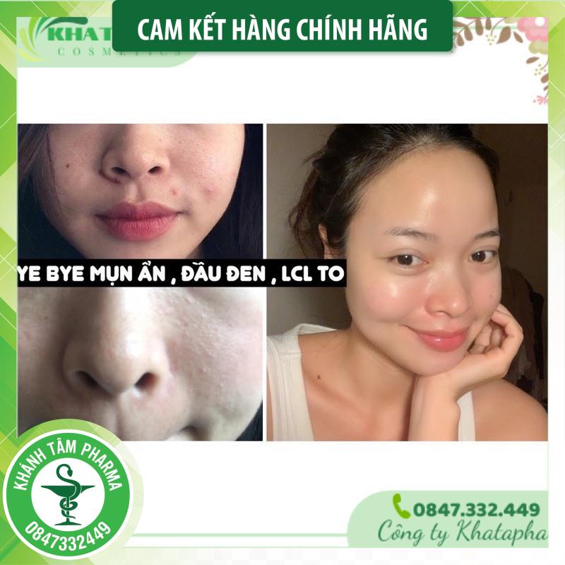 MEGADUO Gel 15g - bản AHA và Plus Retinal 1.0 gel thoa mụn