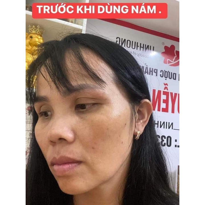 Bộ sản phẩm xoá N.ám , t.àn n.hang , đồi mồi Linh Hương