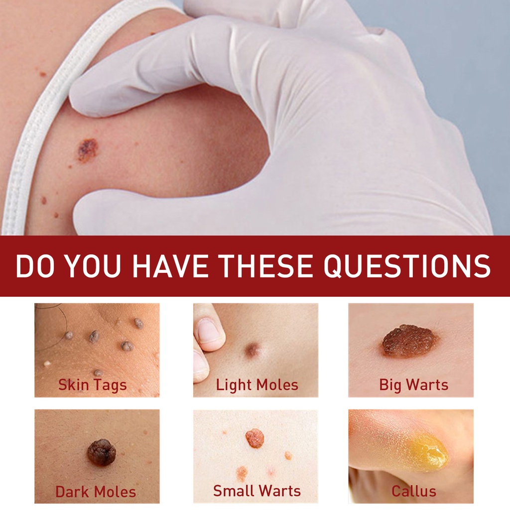 Lột mụn cóc, tẩy nốt ruồi, làm loãng hắc tố, xóa vết thâm, dưỡng trắng và dưỡng ẩm tinh chất vitamin E 20ml