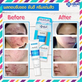 [Chính Hãng] Kem Mụn Acne Cream Yanhee Thái