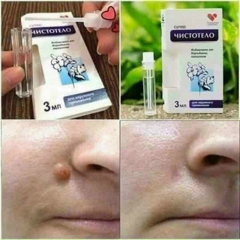 Tẩy mụn cóc mụn cơm nốt ruồi mụn thịt