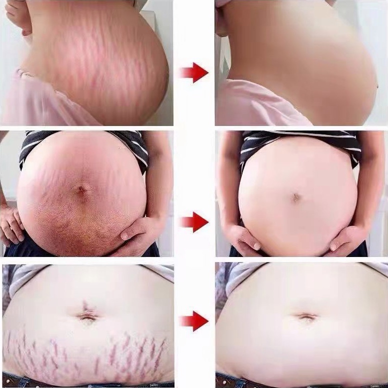 Kem rạn da (Xóa rạn da nhanh chóng trong 7 ngày)Kem xoá rạn da sau sinh làm mờ vết thâm tăng độ đàn hồi cho da làm trắng | BigBuy360 - bigbuy360.vn