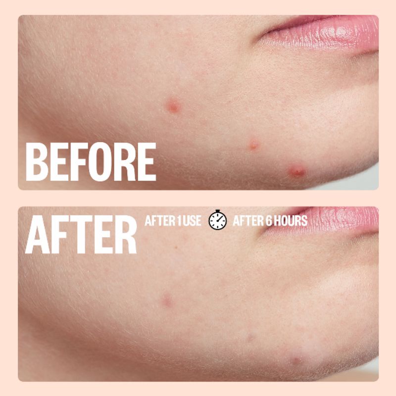 Miếng dán mụn Peace Out Salicylic Acid Acne Healing Dots