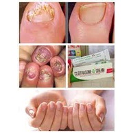 Kem Bôi Nấm Móng Tay Chân CLOTHASONE -D CREAM Thái Lan khỏi nấm , thôi và viêm móng hàng chuẩn chính hãng 100%