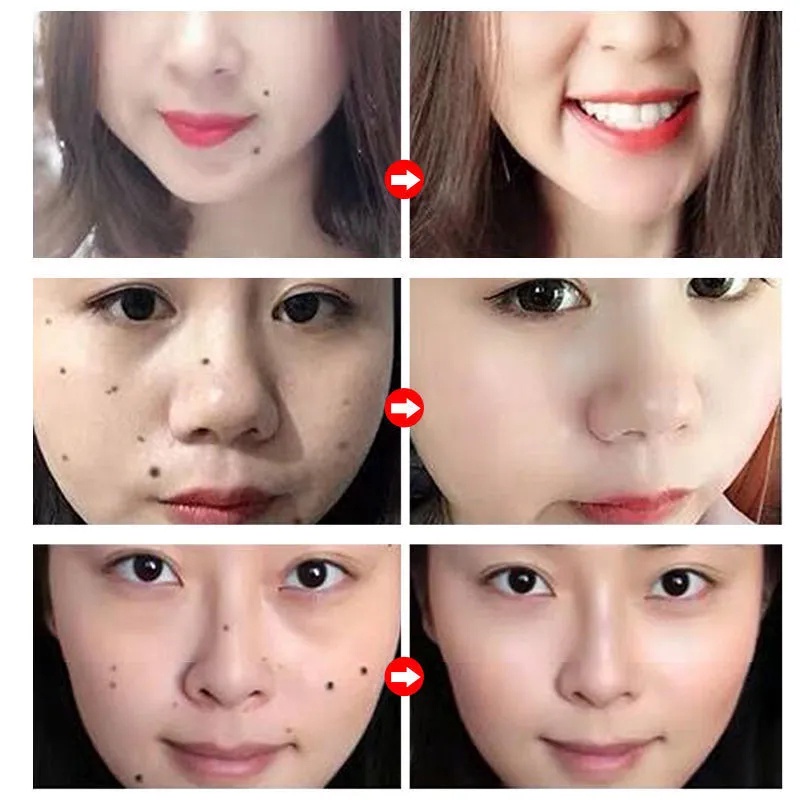 Lột mụn cóc, tẩy nốt ruồi, làm loãng hắc tố, xóa vết thâm, dưỡng trắng và dưỡng ẩm tinh chất vitamin E 20ml