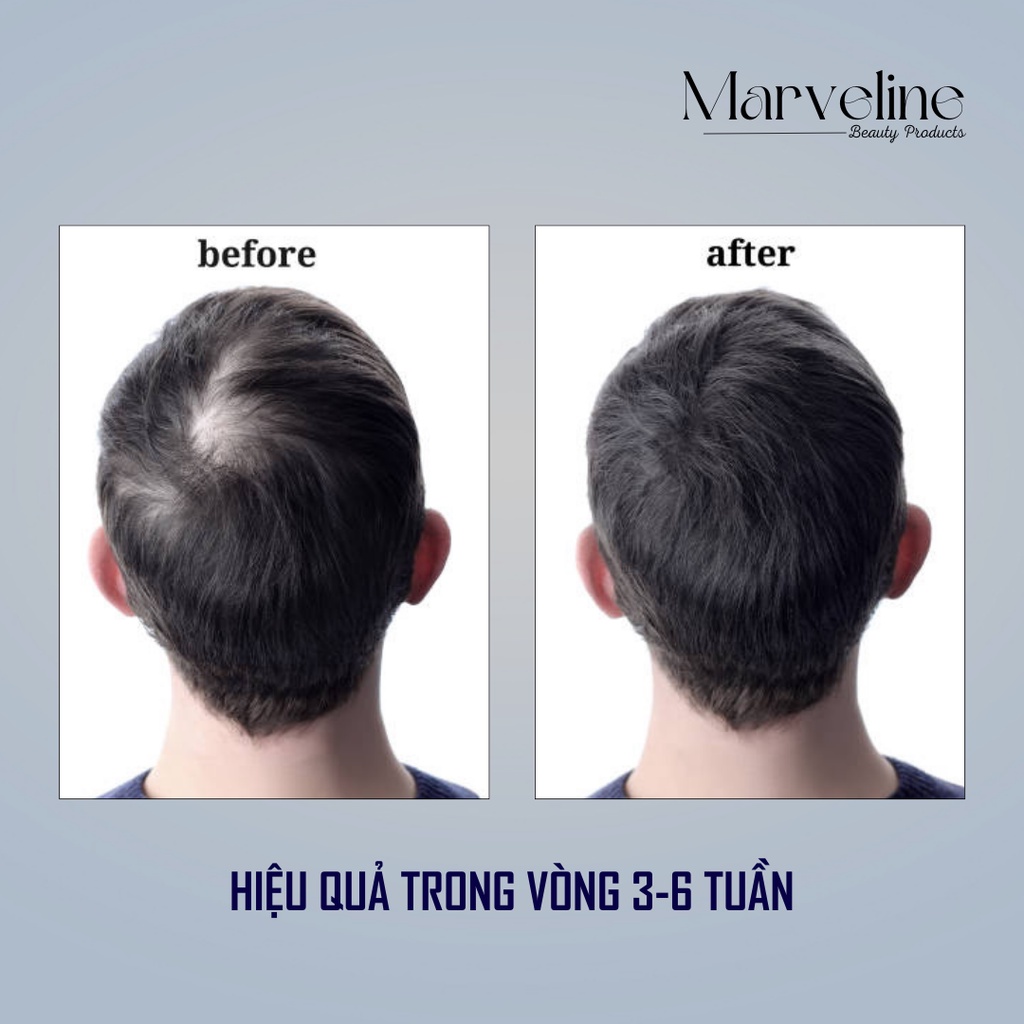 Thuốc kích mọc tóc nhanh Aveline Hair Regrowth Treatment của Mỹ