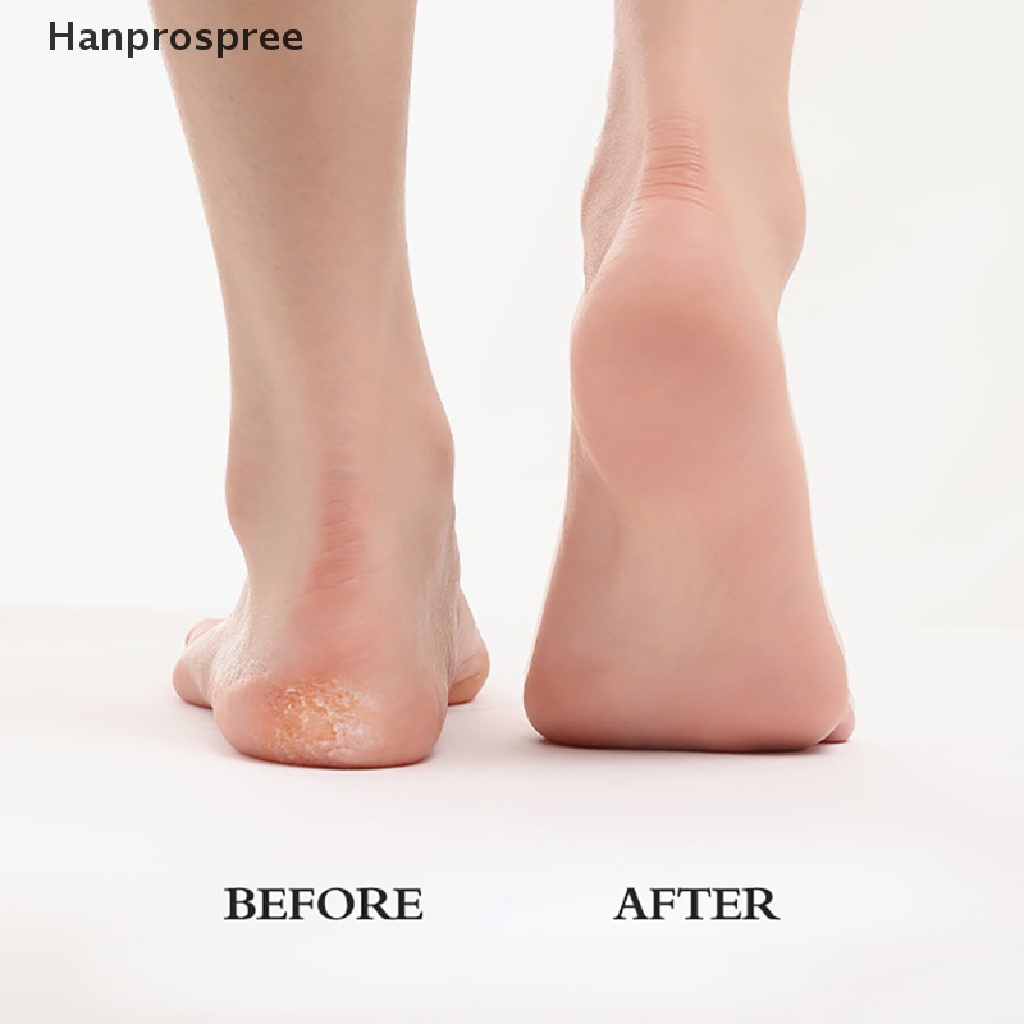 Dụng Cụ Tẩy Tế Bào Chết Cho Bàn Chân Bằng Thép Không Gỉ Hanprospree > Pro