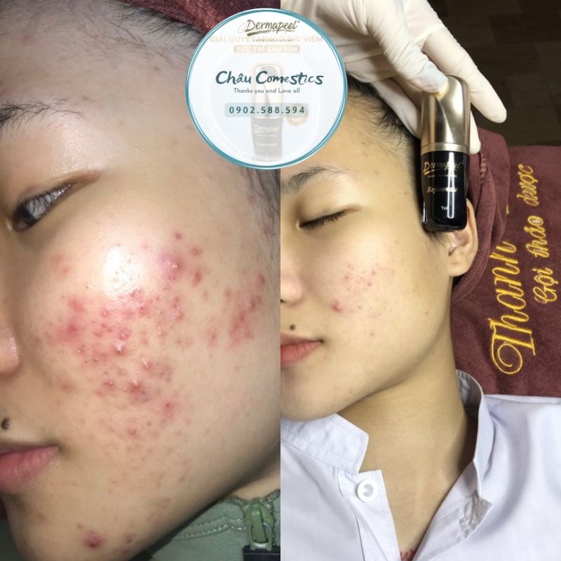 Serum cá tuyết. Xóa tất cả các loại mụn. Tphcm giao trong ngày.