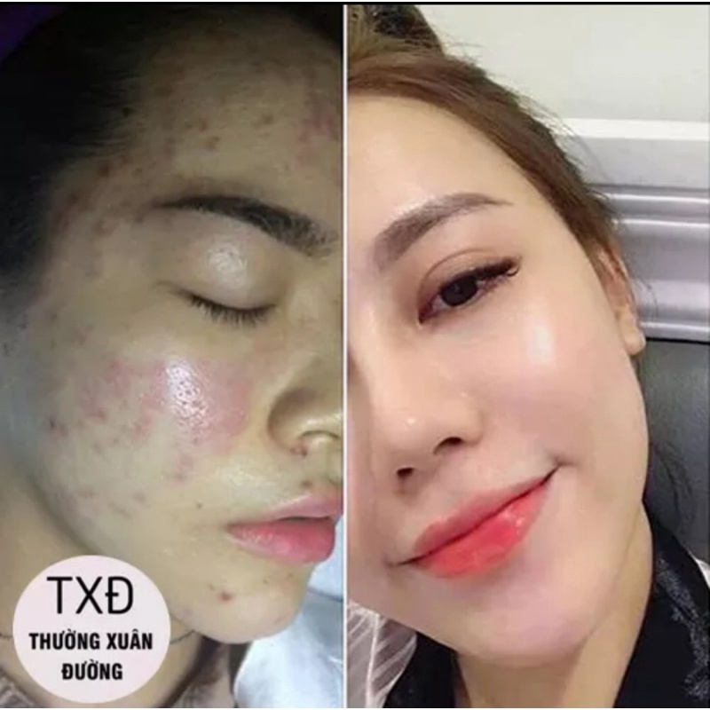 Kem Mụn Hoa Đào nắp đen sạch mụn hết thâm