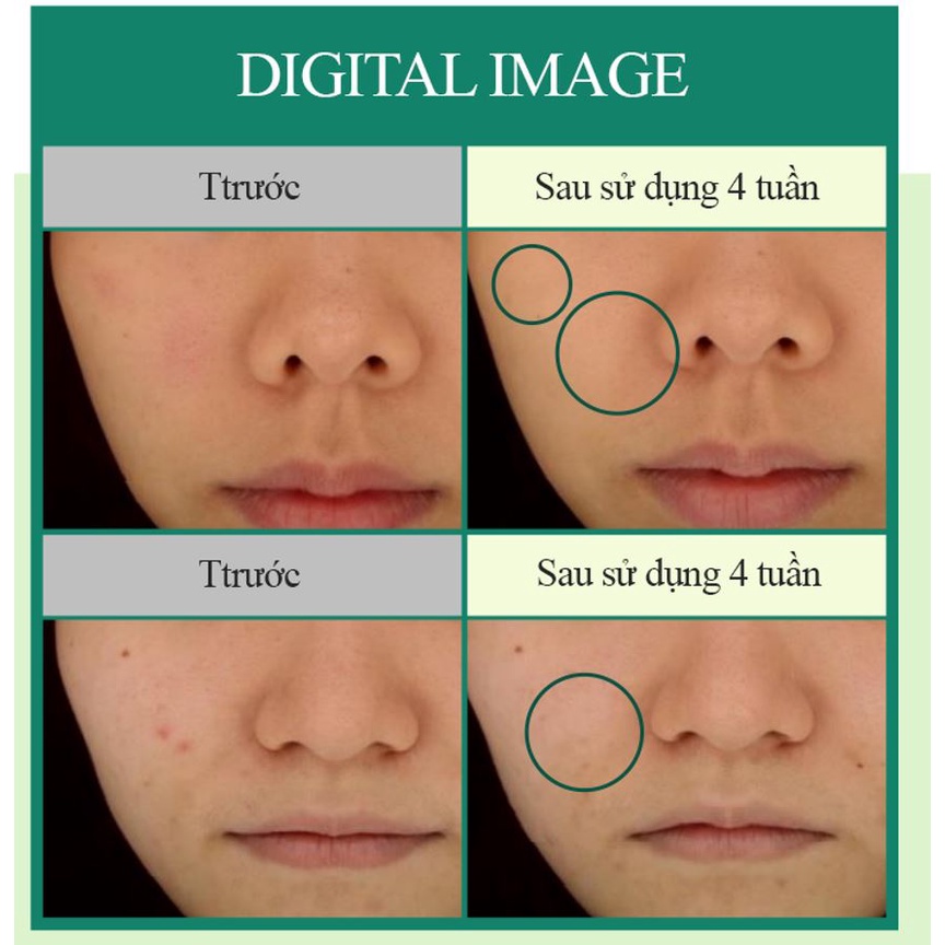 THỎI CHẤM MỤN MEDIPEEL Medi-Peel A.C chiết xuất trà 50ML