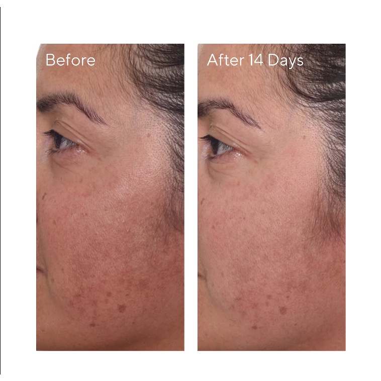 Tinh chất giảm thâm nám Murad Rapid Dark Spot Correcting Serum 30ml