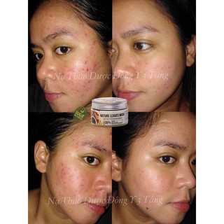 MẶT NẠ THẢO DƯỢC 3 TẦNG