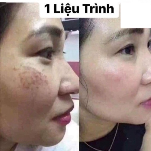 Viên Uống Trắng Da Glutathione 600 Dr Lacir Chính Hãng,làm chậm lão hoá, giảm nếp nhăn, tàn nhan, tăng nội tiết tố