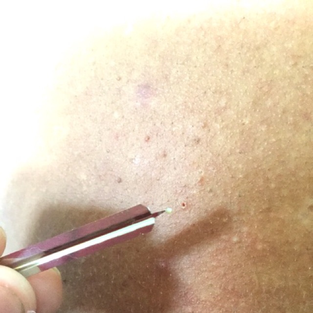 Kim Chích Mụn LANCETS vô trùng - Hộp 200 Kim Chính hãng