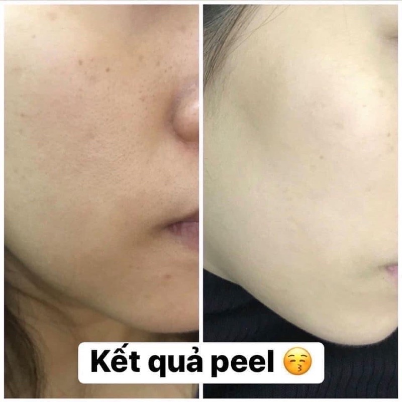 Neostrata Peel Tái Tạo Da, Giảm Nếp Nhăn Ngăn Ngừa Lão Hóa Prosystem Retinol Peel 1.5ml