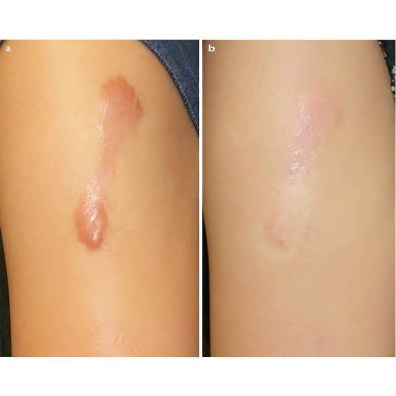 Miếng Dán Ép Sẹo Lồi ECLAR PLASTER Hisamitsu  Nhật Bản