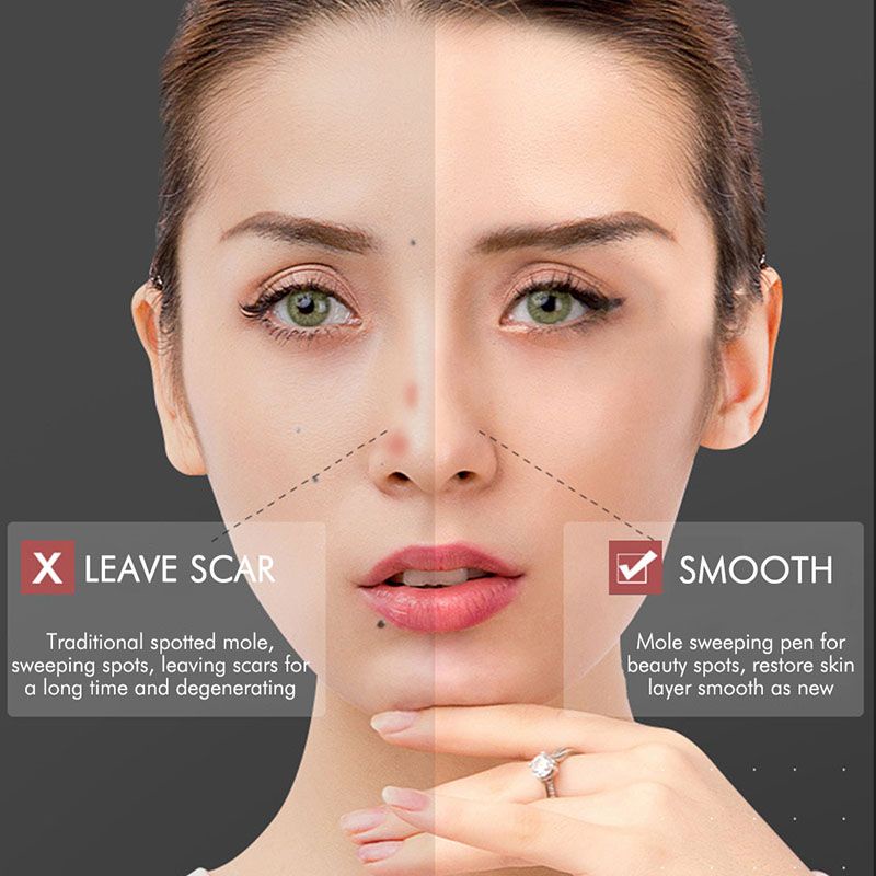 Bút Laser Plasma Xóa Tàn Nhang / Nốt Ruồi / Mụn / Hình Xăm Tiện Dụng