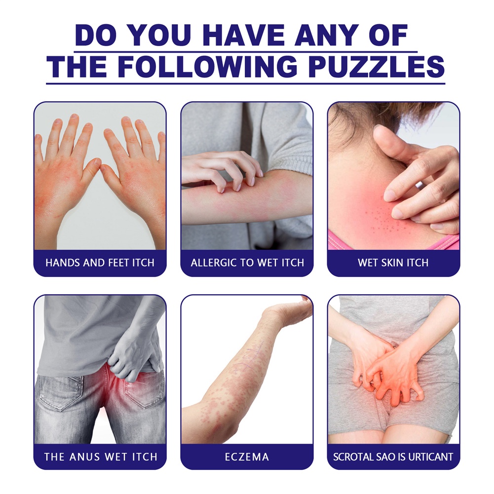 Kem trị bệnh vẩy nến Eczema Chống ngứa Giảm phát ban Da Thuốc mỡ kháng khuẩn Cơ thể đỏ Giảm rêu Thuốc mỡ sử dụng bên ngoài Thuốc mỡ phát ban da có sẵn heby1