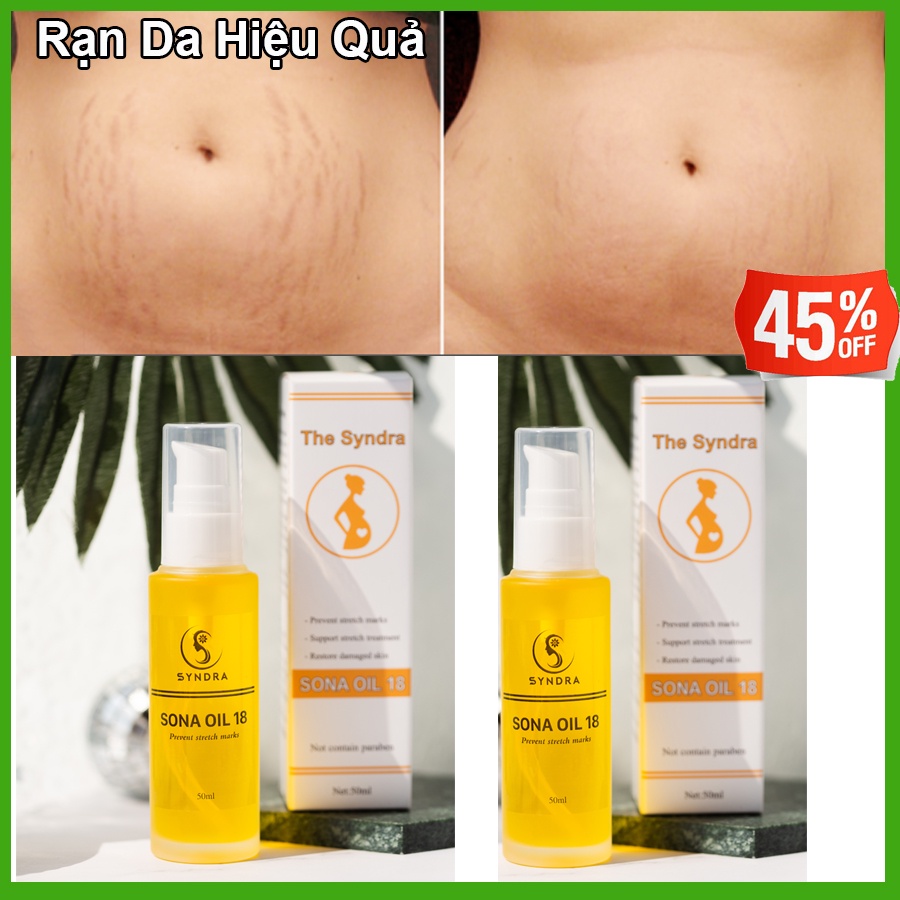 Dầu rạn da cho phụ nữ sau sinh- Sona oil 50ml,Tác dụng nhanh lành tính