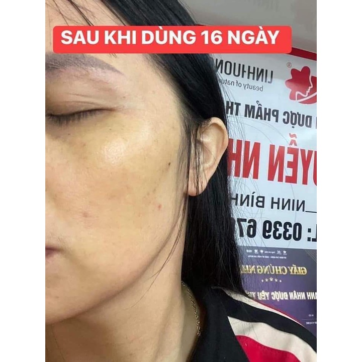 Bộ sản phẩm xoá N.ám , t.àn n.hang , đồi mồi Linh Hương