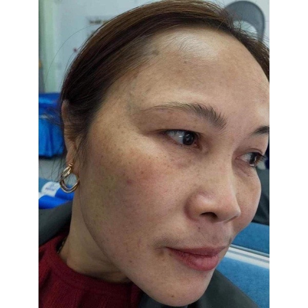 Kem Dưỡng Da Perfect Melasma Mờ Thâm, Nám, Sạm, Tàn Nhang, Dưỡng Trắng Da Hiệu Quả
