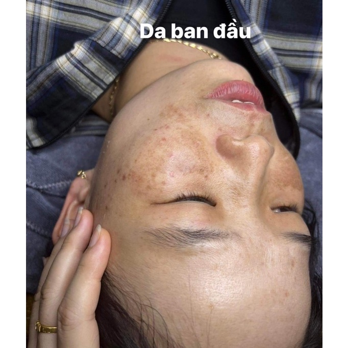 Kem Dưỡng Da Perfect Melasma Mờ Thâm, Nám, Sạm, Tàn Nhang, Dưỡng Trắng Da Hiệu Quả