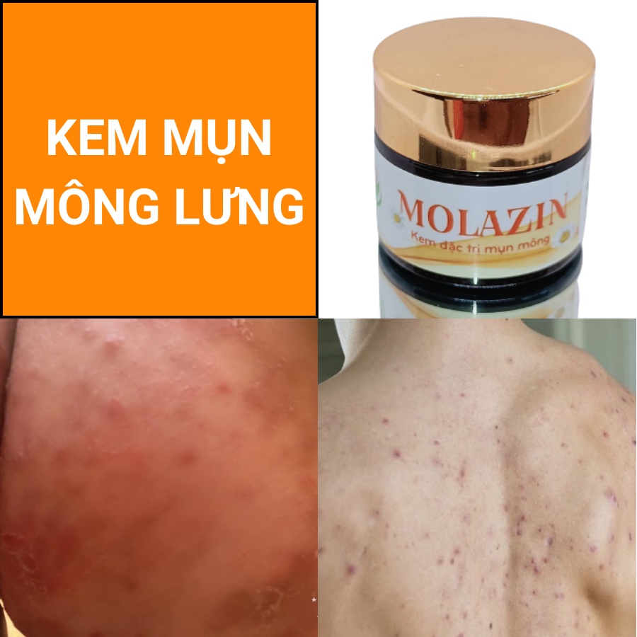 KEM BÔI MỤN MÔNG LƯNG MOLAZIN Sạch Mụn nhọt, Mụn mủ, Mụn liti, viêm nang lông