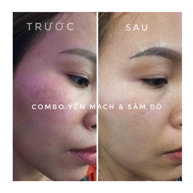 Kem Face Nám SÂM ĐỎ  Ngừa Sạm Nám, Giúp Trẻ Hoá Căng Bóng Da